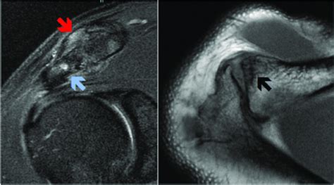 Pre-treatment coronal and axial MRI of the shoulder showing evidence of ...