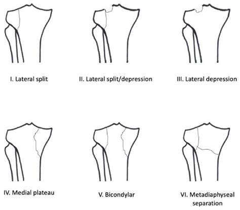 Tibial Plateau Fracture Classification : Tibial Plateau Fracture Classification | eORIF : Medial ...