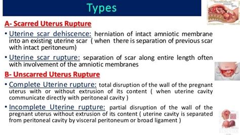 Rupture uterus