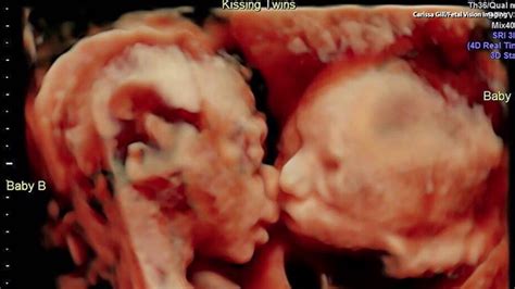 Ultrasound Captures Sweet Moment Between Twins in the Womb - YouTube