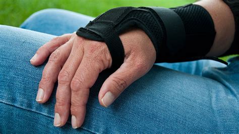 Rheumatoid Arthritis: Treatment with Splints and Braces