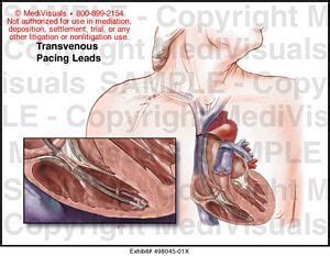 Transvenous Pacing Leads Medical Illustration Medivisuals