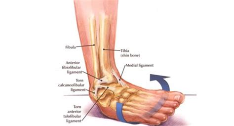 Ankle Sprains: Symptoms, Treatments & Prevention | Watsonia Podiatry