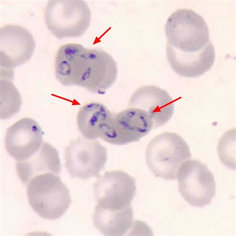 Babesia parasite, babesia infection, symptoms, diagnosis & babesia ...