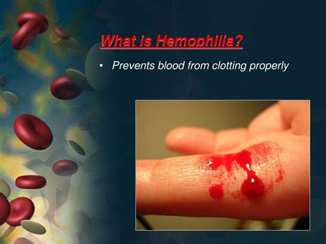 PPT - Hemophilia PowerPoint Presentation, free download - ID:6887267