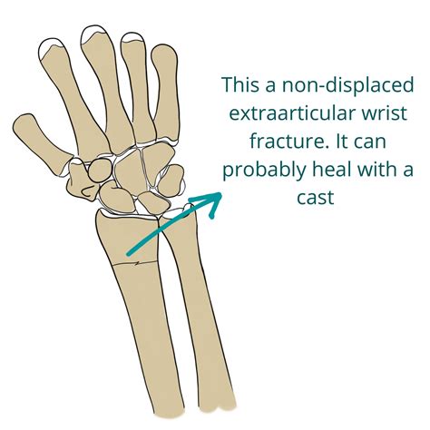 Wrist Fractures (Distal Radius Fractures) - Pro doctor