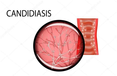 Vaginal mucosa of the patient of the candidiasis Stock Vector by ©Artemida-psy 109266194