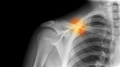 Collarbone Pain: Causes, Symptoms, and Treatment