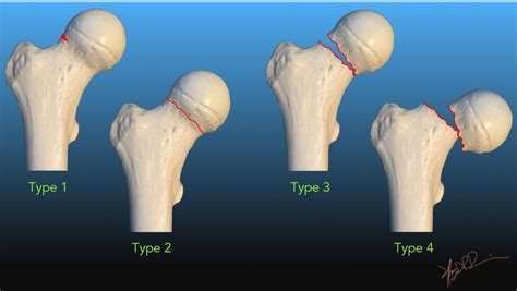 Garden Classification of Femoral Neck Fractures | UW Emergency Radiology