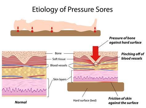 Development of Pressure Ulcers: Causes and Signs – Scottish Acquired Brain Injury Network