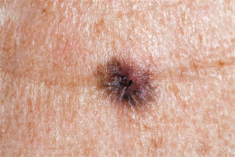 Melanoma: Stages, types, causes, and pictures