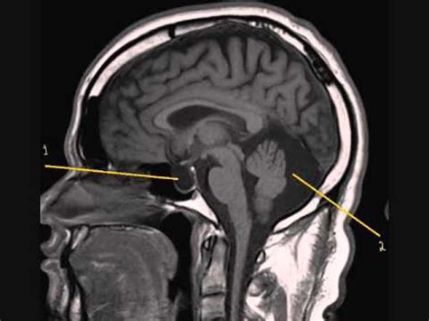 Empty Sella Syndrome and an Arachnoid Cyst 1 0001 - YouTube