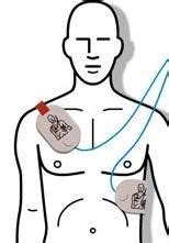 anteroposterior aed pad placement for adults