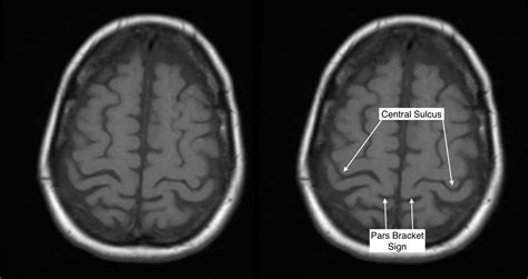 Radiological Anatomy: Central Sulcus - Stepwards