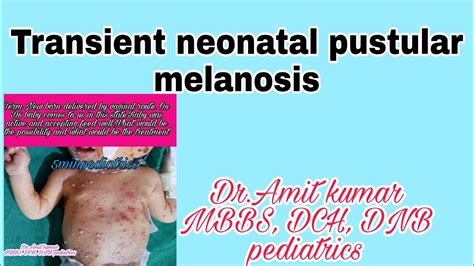 #TRANSIENT_NEONATAL_PUSTULAR_MELANOSIS #5minpediatrics - YouTube