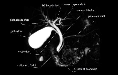 MRI MRCP Anatomy| Free MRI Coronal Cross Sectional Anatomy of the ...