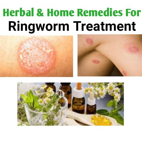 Best Medications For Ringworm Treatment - Public Health