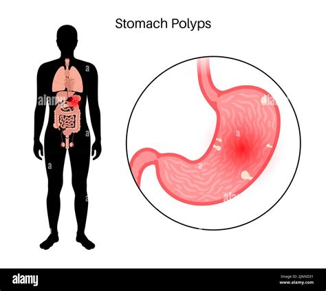 Stomach polyps, illustration Stock Photo - Alamy