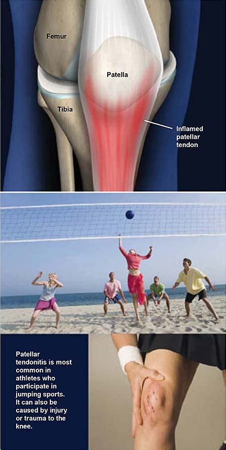 Patellar Tendonitis (Jumper’s Knee) | Central Coast Orthopedic Medical ...