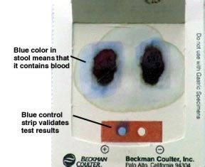 Diagnostic Tools: Hemoccult Card Test