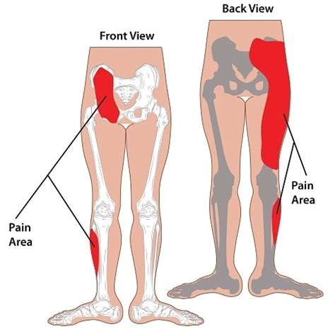 Sacroiliac Joint Pain (SI Dysfunction) - Causes and Symptoms | SportNova UK