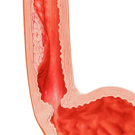 Barrett Oesophagus Symptoms Photograph by Pixologicstudio/science Photo ...