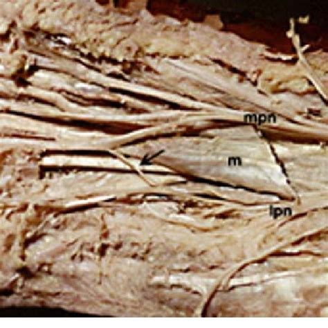 (PDF) Anatomical study of the communicating branches between the medial and lateral plantar nerves