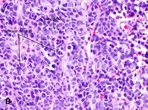 American Urological Association - Small Cell Carcinoma