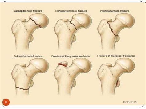 NOF Neck of Femur Fracture | Neck fracture, Fracture, Lower limb