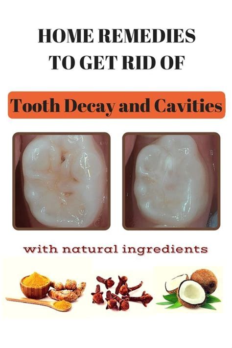 Top Remedies And Tips For Good Gum Care | Tooth decay remedies, Dental decay, Tooth decay