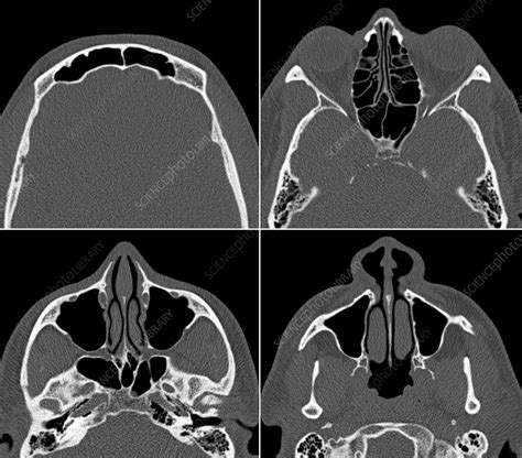 Normal sinuses, CT scan - Stock Image - C029/4634 - Science Photo Library