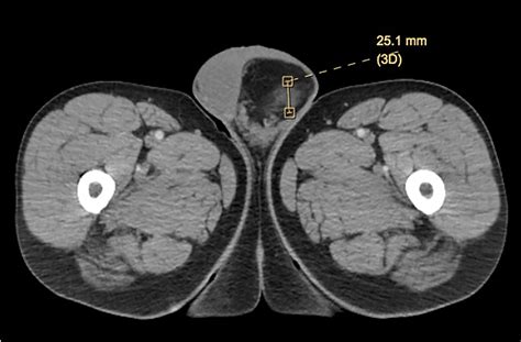 Frontiers | Spindle Cell Lipoma of the Spermatic Cord: A Case ...