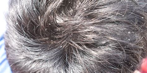 Dandruff: Causes, Symptoms, Treatment, Affect of Diabetes