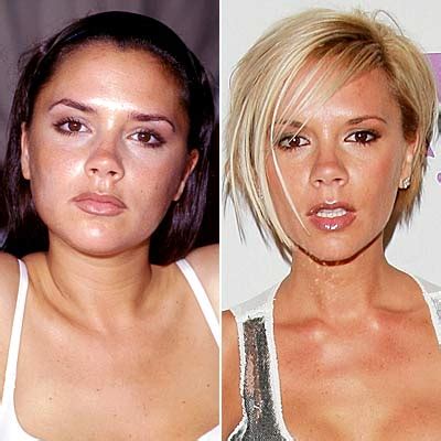 best plastic surgery: When Celebrity Plastic Surgery Has Gone Bad