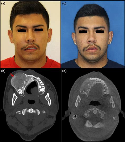 Fibrous dysplasia of bone: craniofacial and dental implications - Burke - 2017 - Oral Diseases ...