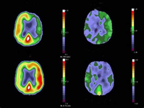 PET scan (positive emission tomograpy) information | myVMC