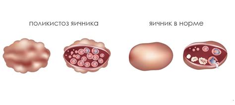 Ответ: Что можно есть после удаления кисты