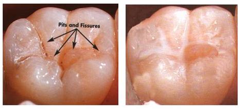 Pit and fissure sealants - Sri Vinayaga Dental Clinic