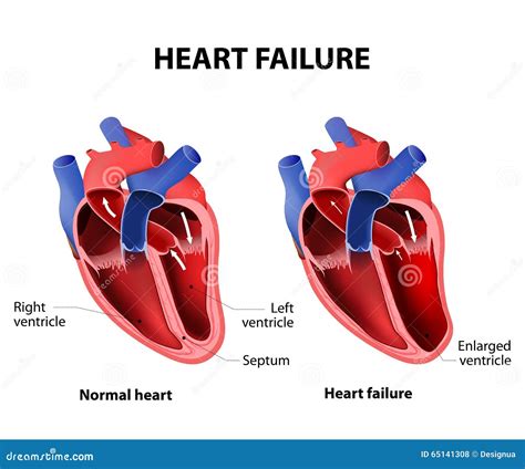 Heart Failure Stock Vector - Image: 65141308