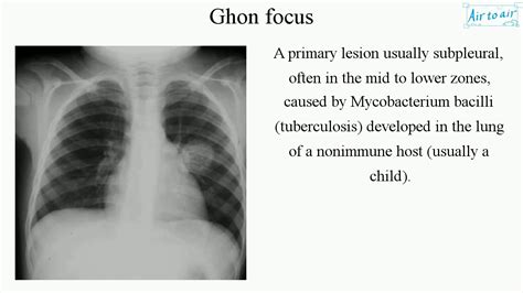 Ghon focus (English) - Medical terminology for medical students - - YouTube