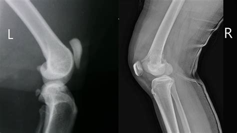 Patella Alta | Pain and Instability of the Knee Cap