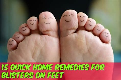 15 Quick Home Remedies for Blisters on Feet - Home Remedies