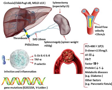 A preliminary summary of risk factors for portal vein thrombosis after ...