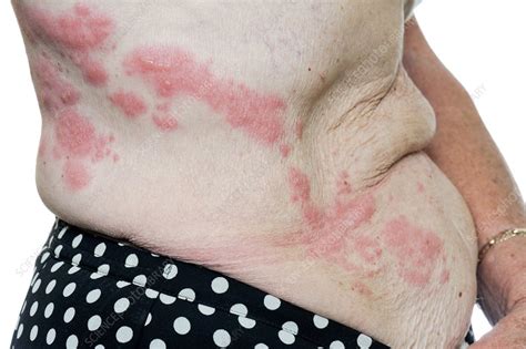 Shingles rash - Stock Image - C023/8970 - Science Photo Library