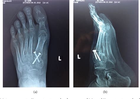 Cuneiform Bone Fracture