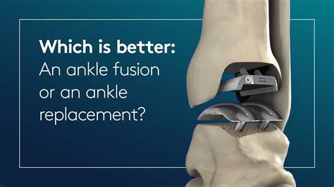 Which is better an ankle fusion or an ankle replacement? - YouTube