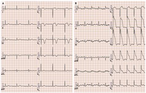 How to Spot Wellens’ Syndrome - האיגוד הישראלי לרפואה דחופה