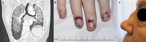 ANCA associated vasculitis | The BMJ