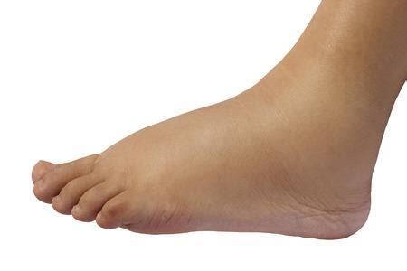 7 Reasons for Swelling in Feet and Ankles: Affiliated Foot & Ankle Care ...