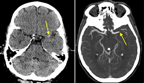 Middle Cerebral Artery Anatomy - Anatomical Charts & Posters